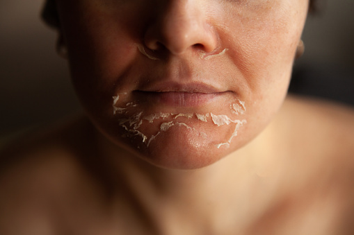 peeling - tca - esthetique visage.jpg