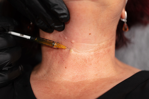 injection visage - mesolift.jpg